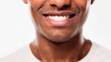 Clareamento Dental: Vale a Pena Fazer?